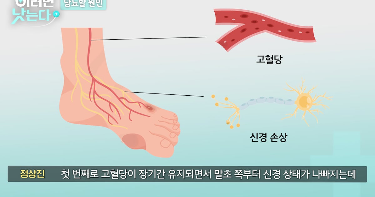 방심하다 발가락 자른다… 당뇨보다 무서운 ‘당뇨발’ 경고 증상 5가지