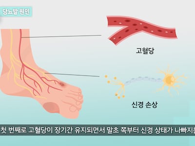 심하면 다리 절단까지... 당뇨보다 무서운 ‘당뇨발’ 의심 증상 5가지