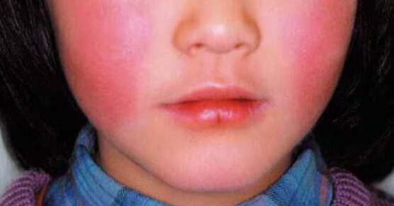 사과병이란 감염성 홍반은 양볼이 불근 발진이 일어나는게 특징이다. 사과병이란 감염성 홍반은 양볼이 불근 발진이 일어나는게 특징이다.