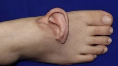 Image 3 for Chinese team completes world's first full ear reattachment