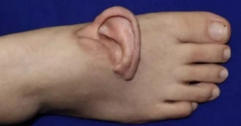 Chinese Winged Ear Chinese Woman’s Ear Reattached via Foot Transplant