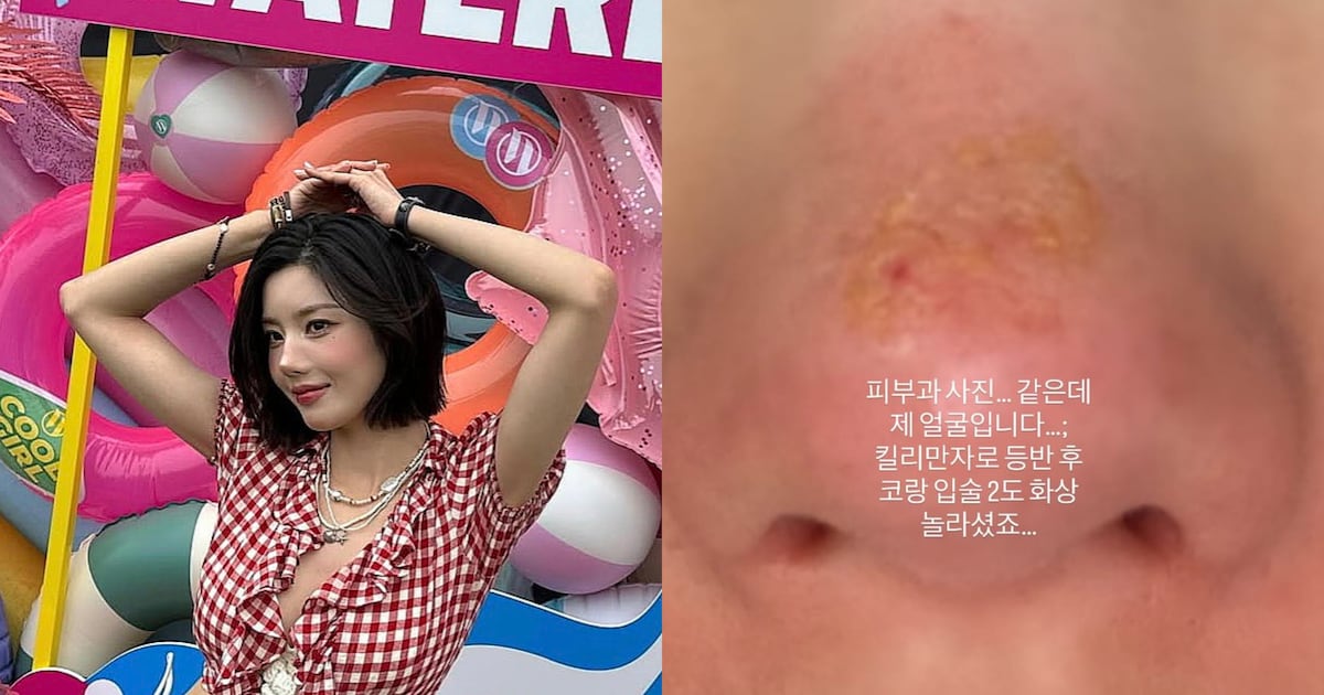권은비 킬리만자로 갔다가 얼굴에 화상 입은 거 봤냐 ㄷㄷ