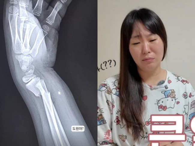 '오형제맘' 정주리, 9살 둘째子 '손목 골절' 응급 사태..충격에 '말잇못'