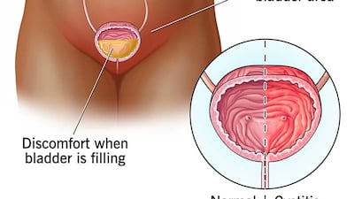 방광통증증후군으로도 불리는 간질성 방광염은 방광 부위(치골 상부)에 만성적인 통증과 압박감이 나타나는 질환이다. 평소보다 소변을 자주 보는 ‘빈뇨’와 갑작스럽게 배뇨감을 느끼는 ‘절박뇨’가 대표적인 증상이다./미국 클리브랜드 클리닉
