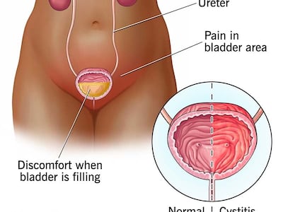 방광통증증후군으로도 불리는 간질성 방광염은 방광 부위(치골 상부)에 만성적인 통증과 압박감이 나타나는 질환이다. 평소보다 소변을 자주 보는 ‘빈뇨’와 갑작스럽게 배뇨감을 느끼는 ‘절박뇨’가 대표적인 증상이다./미국 클리브랜드 클리닉