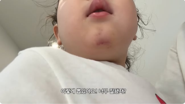 '턱 3cm 찢어졌던' 랄랄 2살 딸, 실밥 제거 성공..."흉터 관리만 남아"
