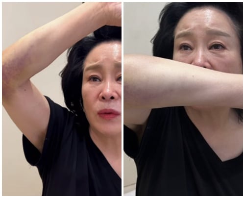 시퍼런 멍 어쩌나…미자母전성애, 욕실 낙상 후 "기적"