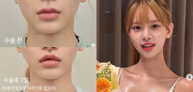맹승지, '인중축소+입꼬리 성형' 후 확 달라진 얼굴.."더 어려보여" 만족