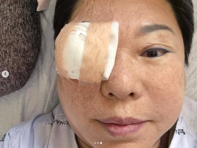 양희은, 각막 이식 수술 받았다.."여러 날 누워만 있어야 해"