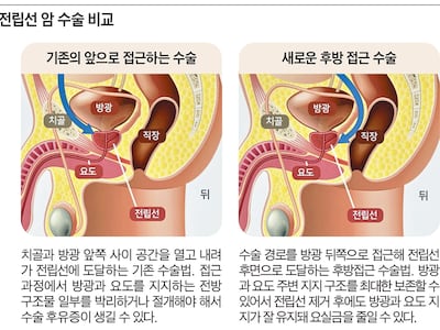 전립선암 제거 ‘앞’ 아닌 ‘뒤’로 했더니… 후유증 확 줄어